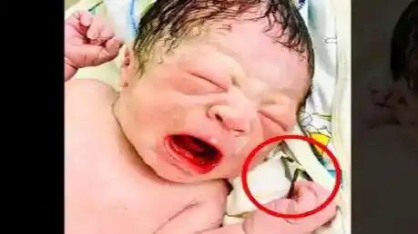 Baby born with a contraceptive IUD in hand