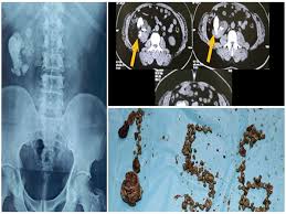 156 stones taken out of the man body in Hyderabad
